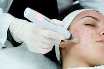 Microneedling